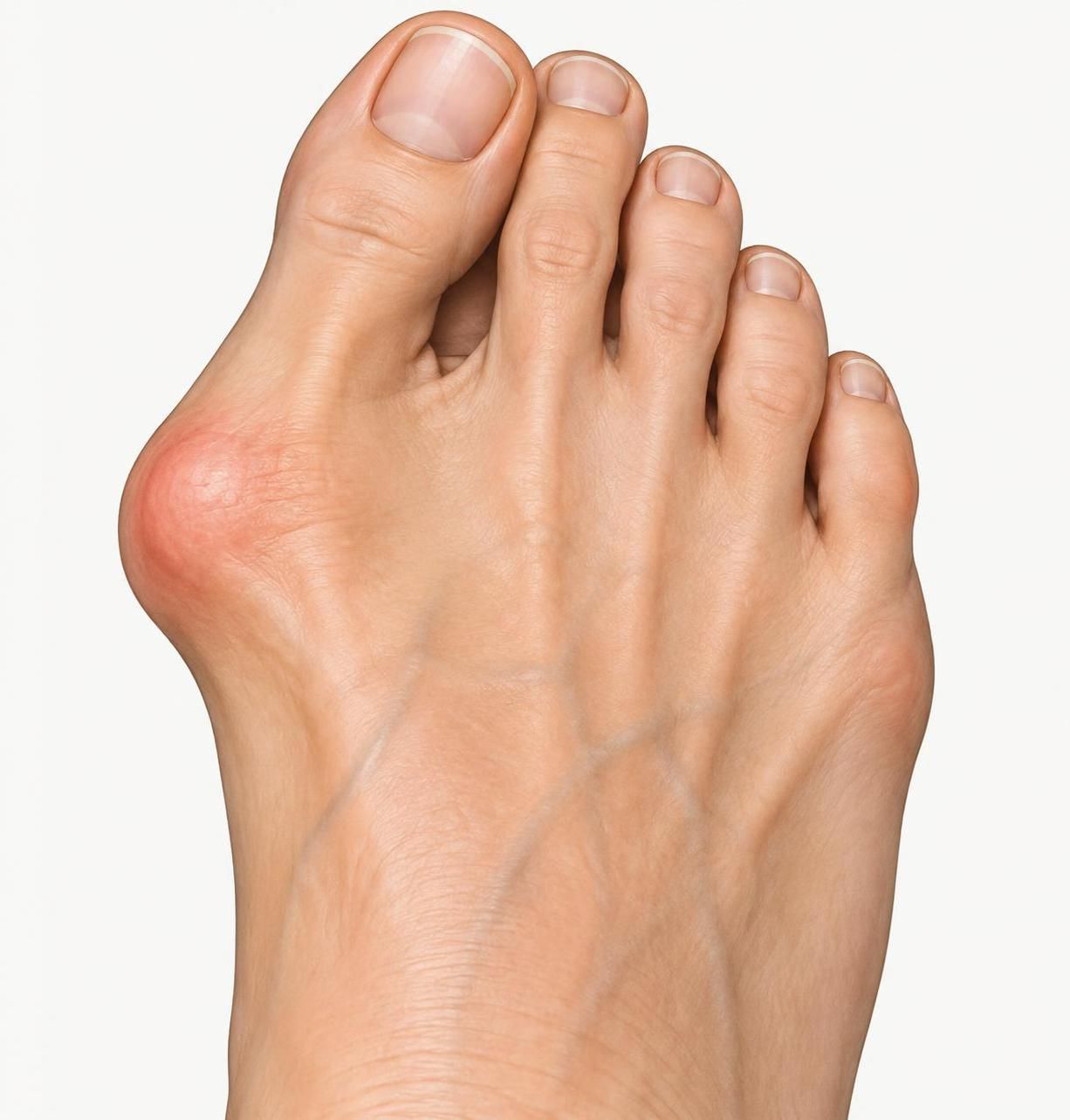 douleurs persistantes, difficulté à marcher : découvrez quand envisager une opération de l’hallux valgus et quelles solutions discuter avec un spécialiste.